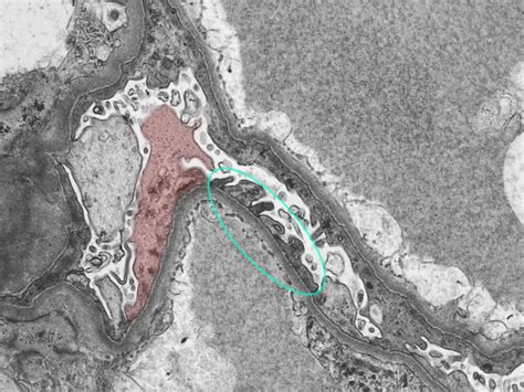 spike and dome appearance|nephritic syndrome usmle.